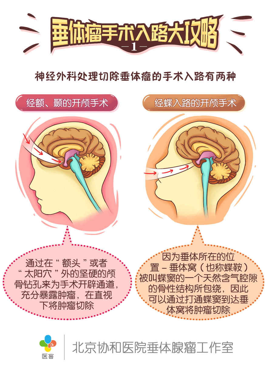 【医客工作室】医疗科普漫画:垂体瘤手术入路