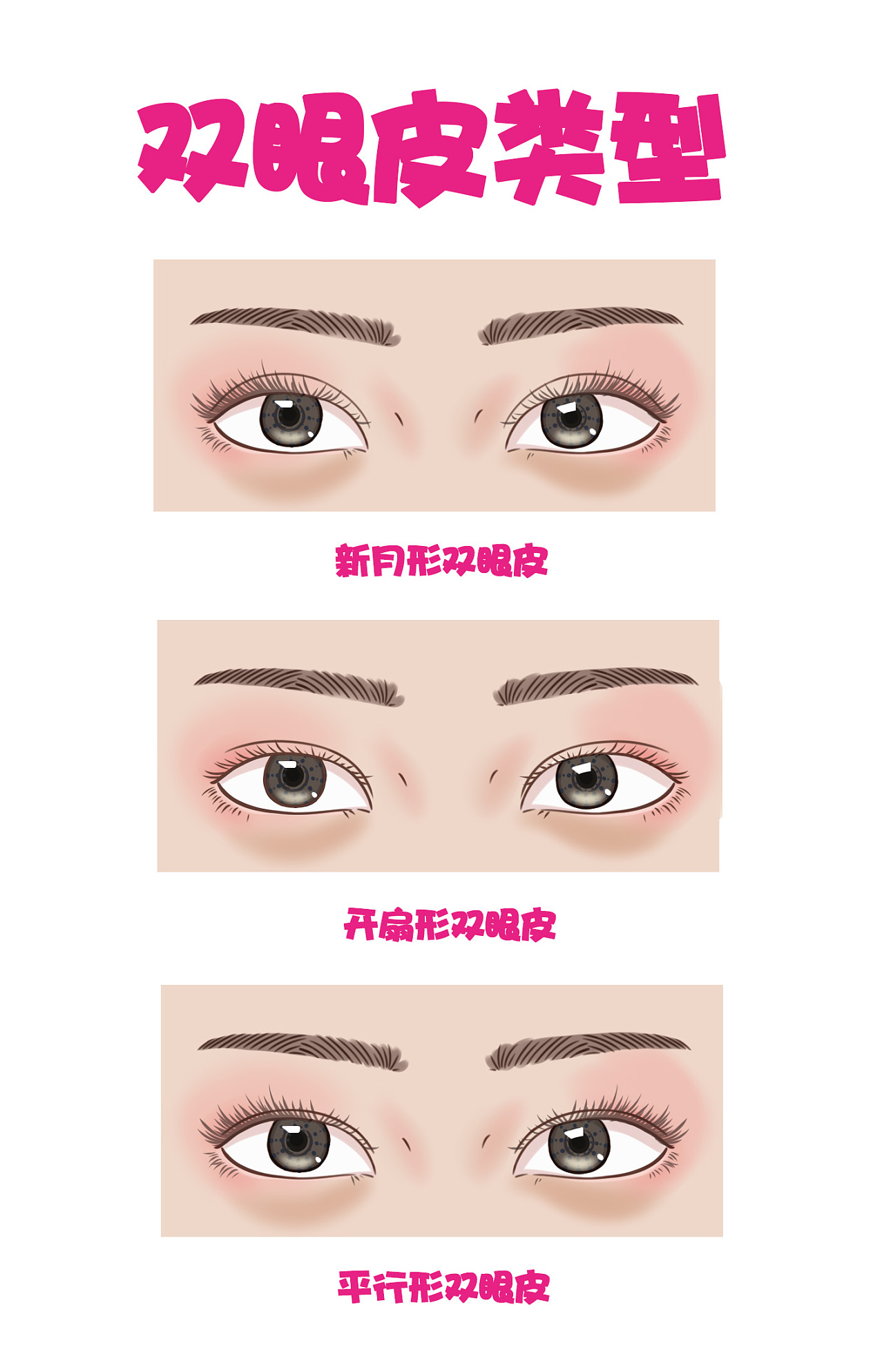 双眼皮分类--双眼皮手术设计