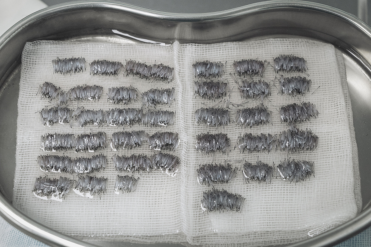 植发手术 提取出来的毛囊 下面有大冰块低温保存中