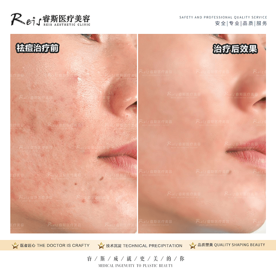 医美皮肤科案例对比图
