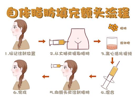 自体脂肪填充额头