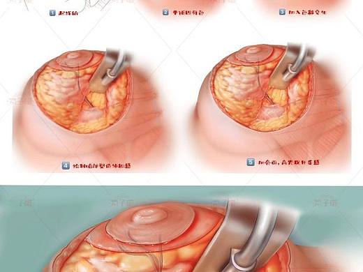 医学插图/步骤题