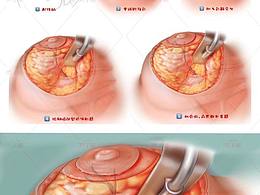 医学插图/步骤题