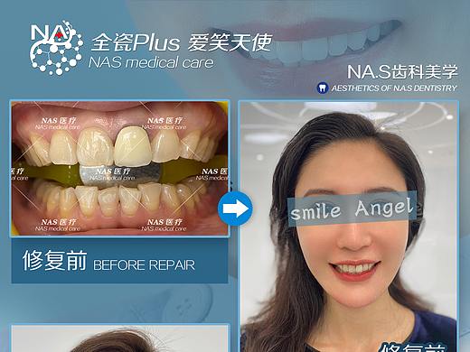 瓷贴面案例（个人主页-ZNDkyNTE1OTI=） - 海报 - 站酷设计师林叉叉爱吃肉原创素材 - 站酷ZCOOL