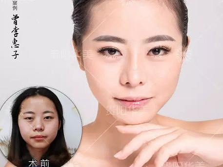 贵阳华美芭比俏鼻隆鼻效果好吗?