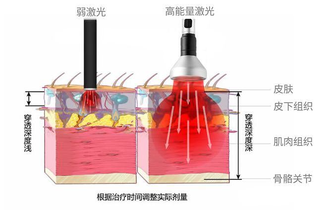 对于不同部位的疼痛疾病,需要选择不同波长的激光,以确保照射时能达到想要治疗的部位,获得预期的治疗效果。高能量激光疗法治疗的效果由功率和波长决定,组织中的最佳激光波长应在650-1100nm。
Summus P4理疗激光采用近红外波长,其最大穿透深度可以达到15cm,对组织深部均有明显的治疗作用,在肌肉骨骼类疼痛疾病的病例中效果更明显。