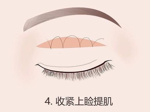 上眼睑矫正