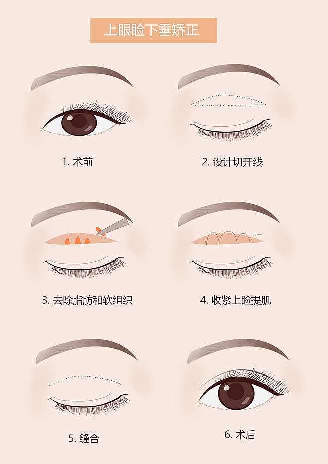 上眼睑矫正（图ZMTgyODk5MTk2） - 创作习作 - 站酷设计师没事画画哦原创素材 - 站酷ZCOOL