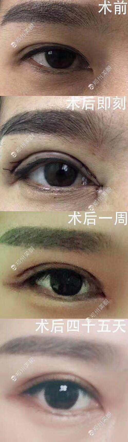 双眼皮做窄了修复双眼皮修复效果（图ZMjA1OTY2Njcy） - 其他 - 站酷设计师郑州双眼皮医生原创素材 - 站酷ZCOOL