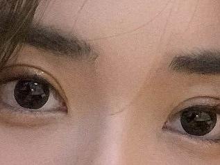 郑州双眼皮医生张行案例