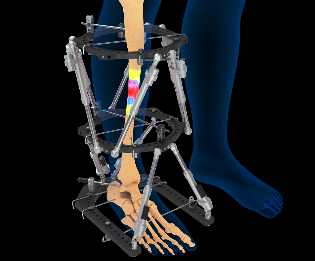 医疗骨折矫正康复手术三维动画