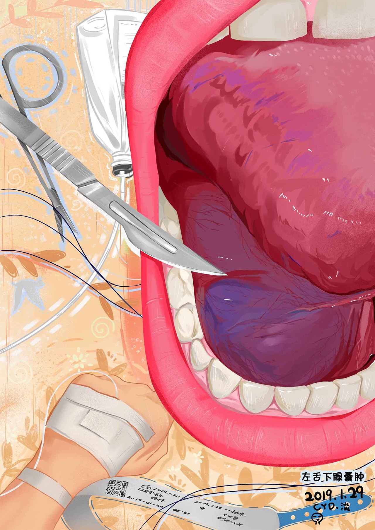 记录一下,左舌下腺囊肿