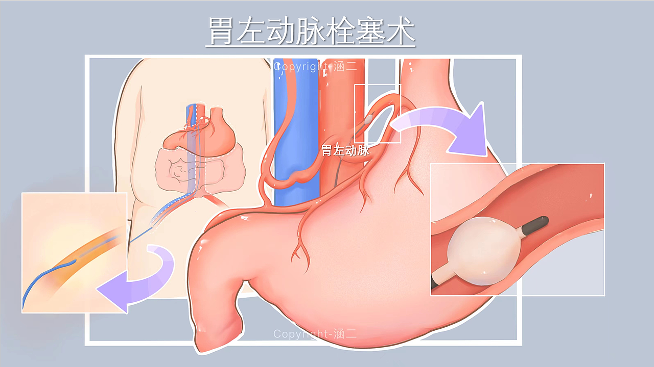 医学插画｜胃左动脉栓塞术（图ZMjg4ODIwMjM2） - 创作习作 - 站酷设计师涵二原创素材 - 站酷ZCOOL