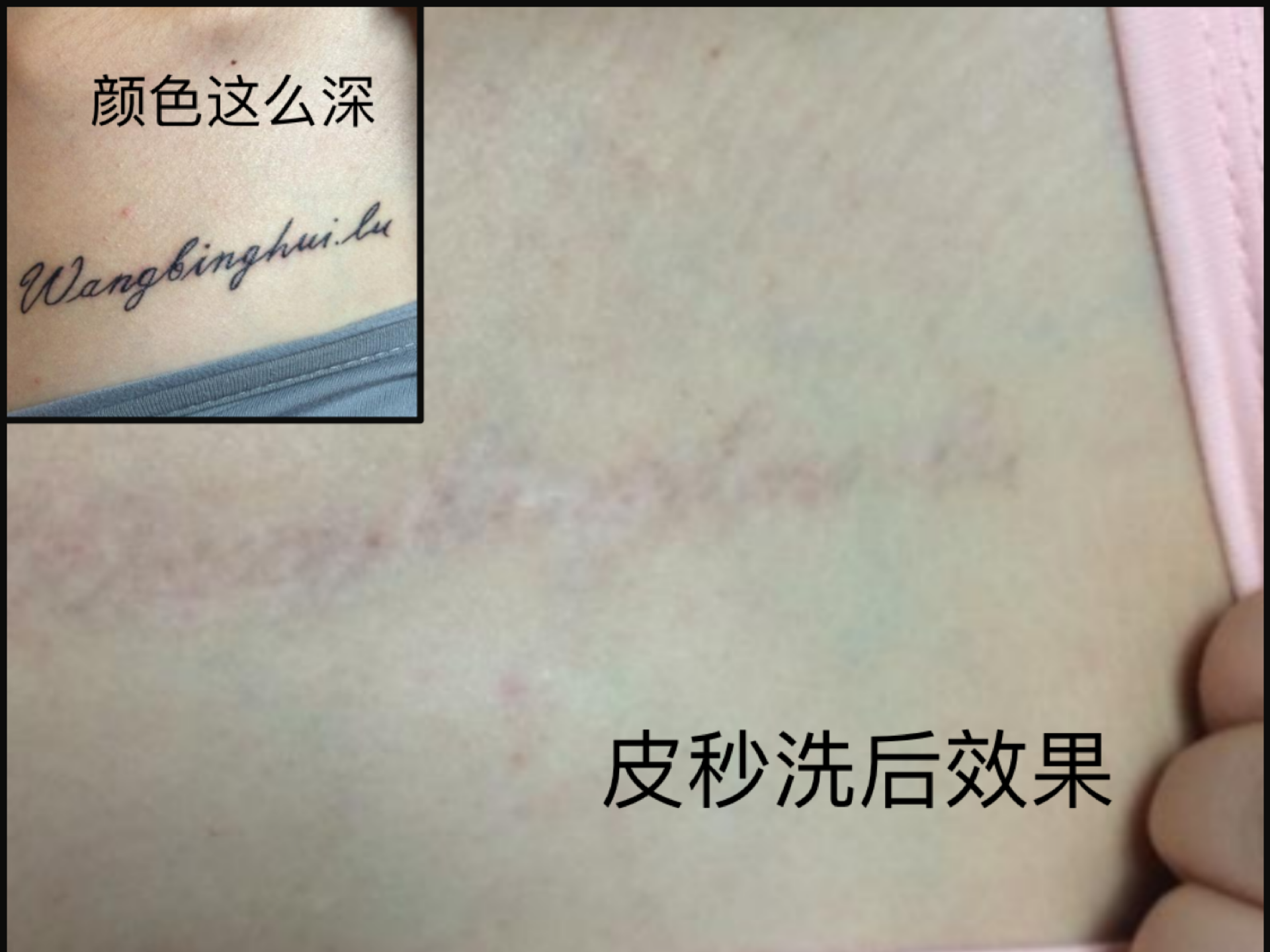 纹身素材第1212期——疤痕上的艺术 - 疤痕遮盖纹身修改 武汉老兵纹身