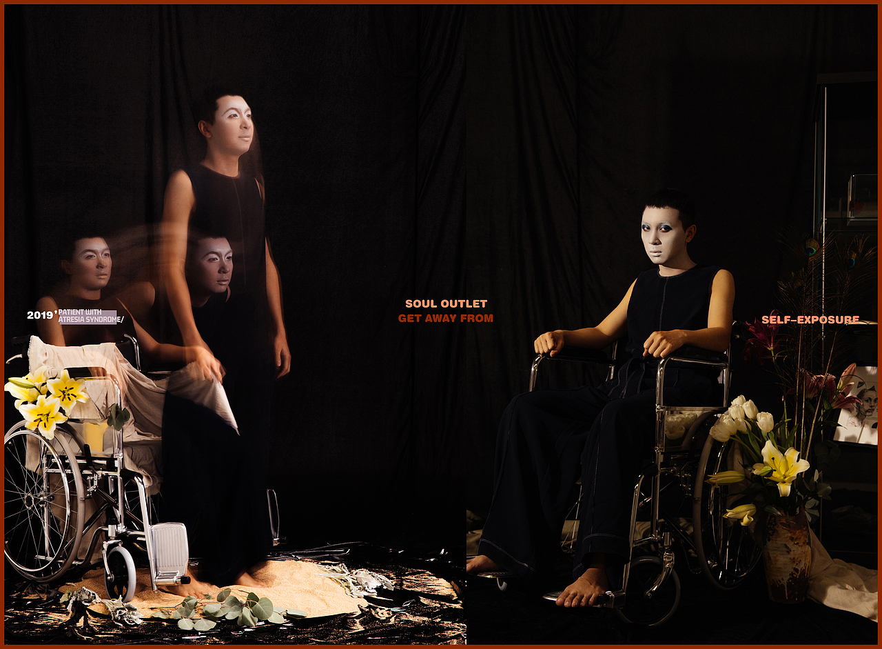 《闭锁综合症》