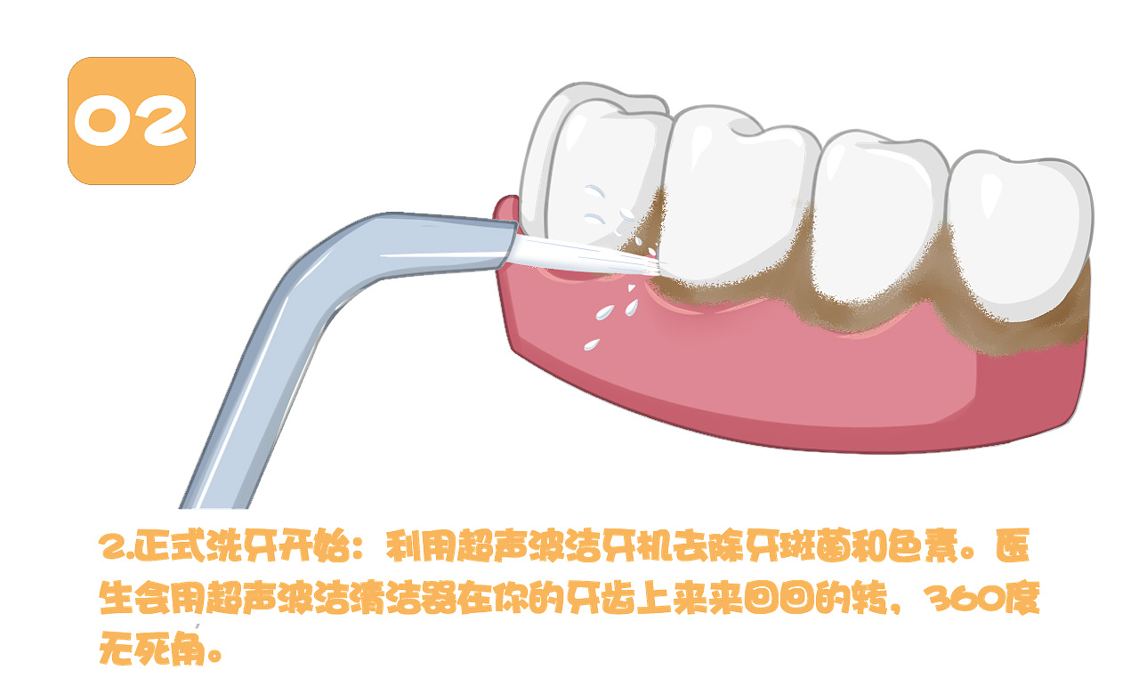 北京丽合口腔中心-洁牙的注意事项和正确洁牙方法 - 哔哩哔哩