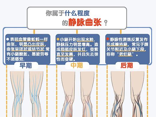 静脉曲张形成的原因及静脉曲张注意事项