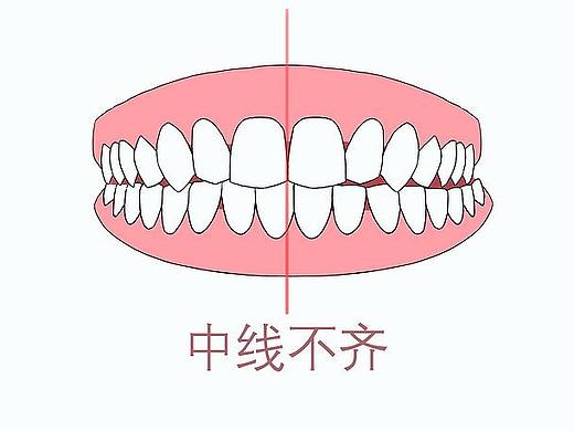 牙齿，口腔，牙齿矫正，龅牙，虎牙，牙齿不齐