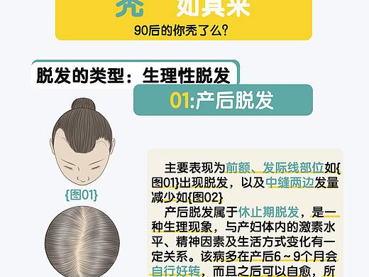 脱发类型 
