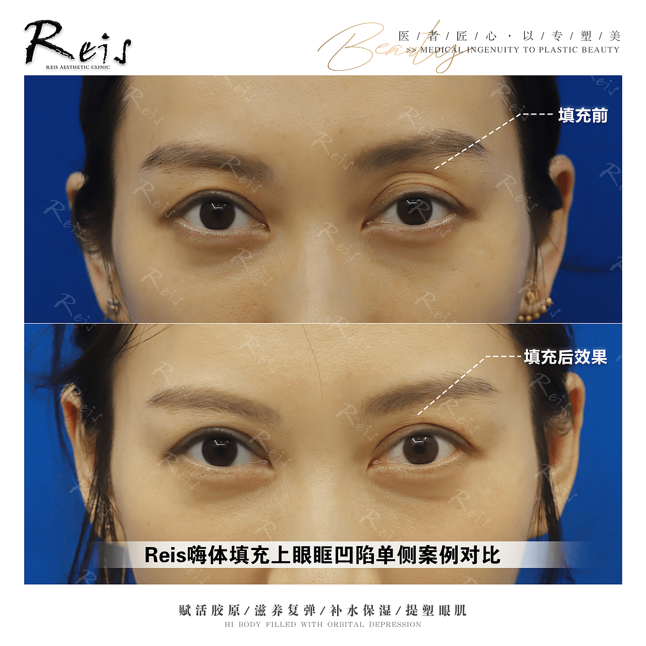 医美皮肤科案例对比图