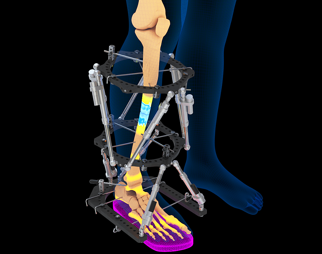 膝关节保住了！——一例成功的PSI引导下胫骨高位截骨手术 - 知乎