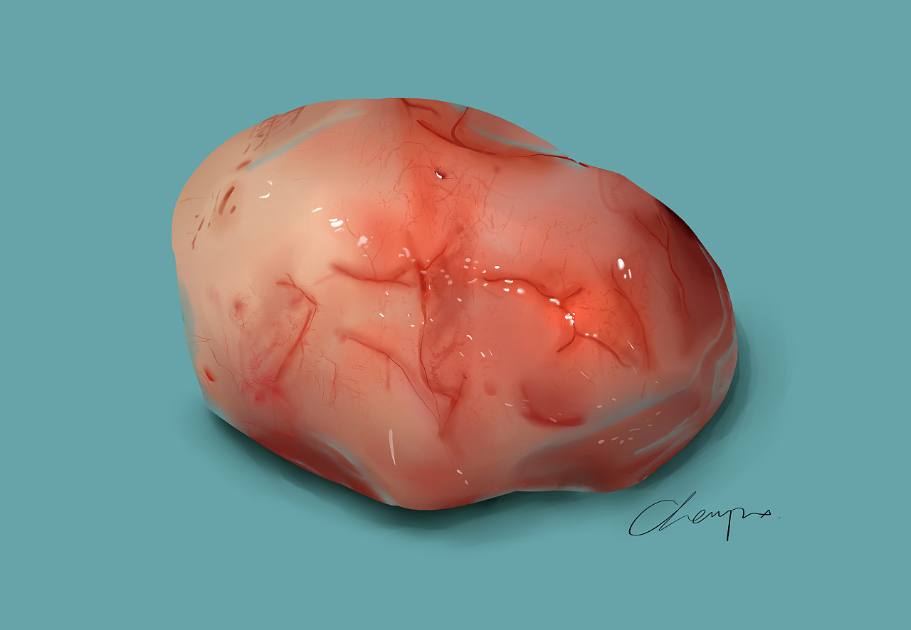 【医学插画】肿瘤君