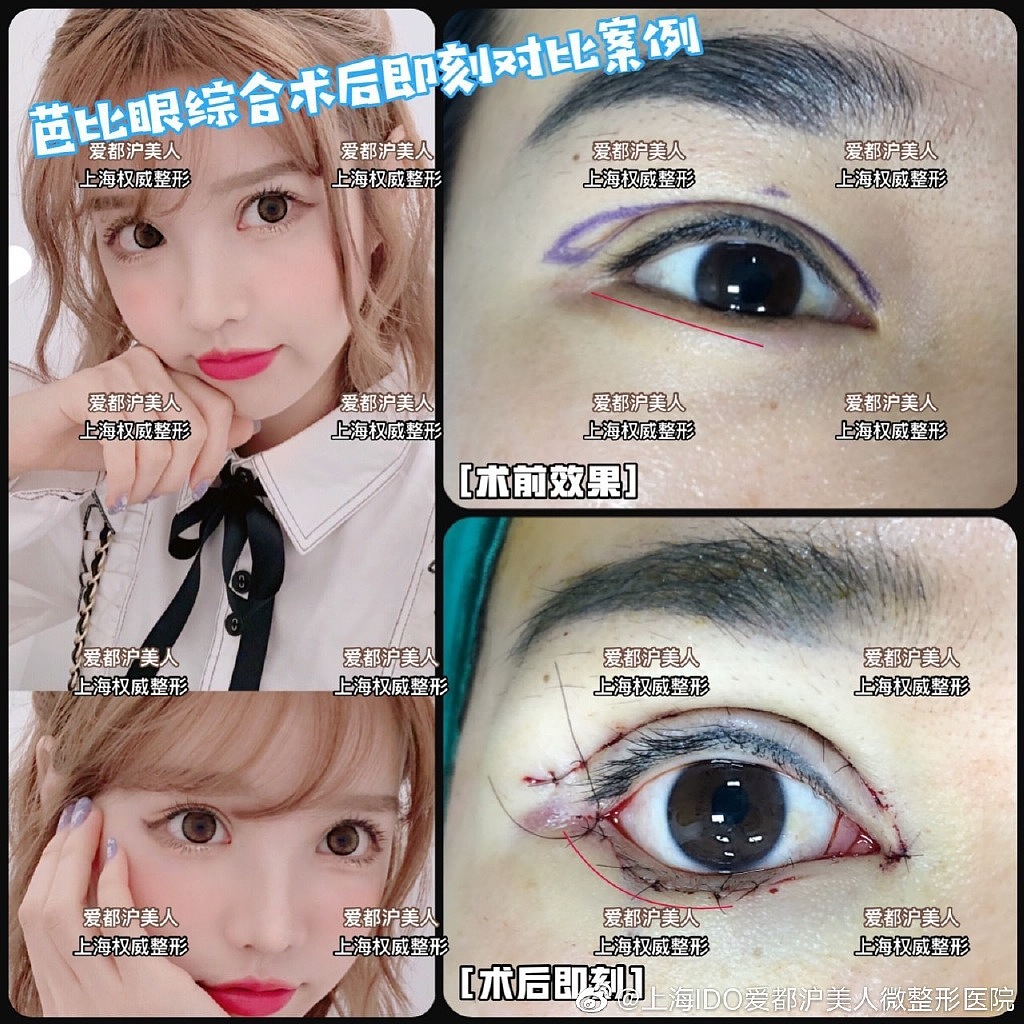 整形案例-网红风