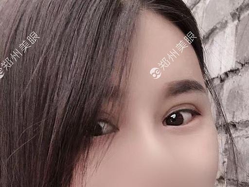双眼皮失败大肉条修复
