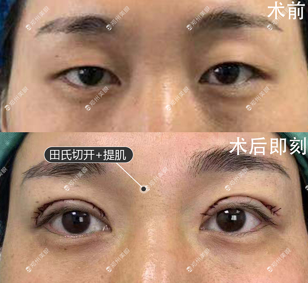 郑州双眼皮自然风格田氏双眼皮（图ZMjA2NTczODQw） - 其他 - 站酷设计师郑州双眼皮医生原创素材 - 站酷ZCOOL