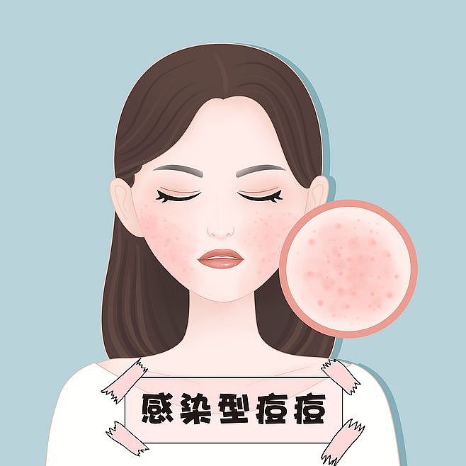 医美、脸部、痘痘、粉刺