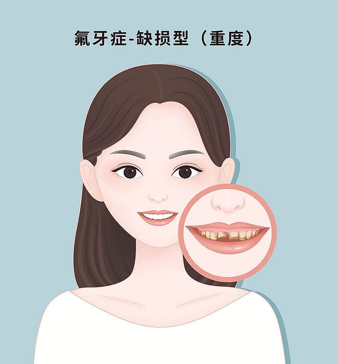 氟牙症,口腔,牙齿