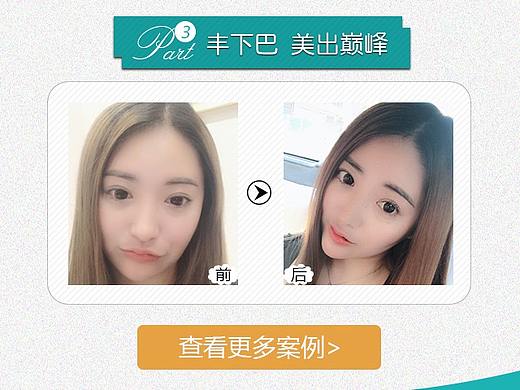 自体脂肪丰下巴