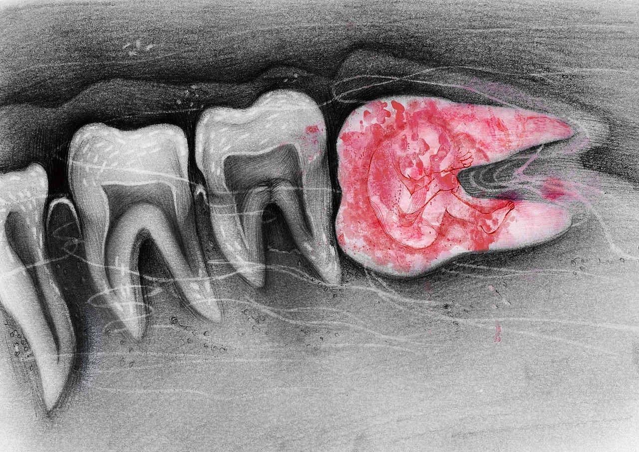 【1241/0527】
着陆点：左侧牙龈<br>智齿的生长周期就和童年一样短暂<br>我想我必须要长大了