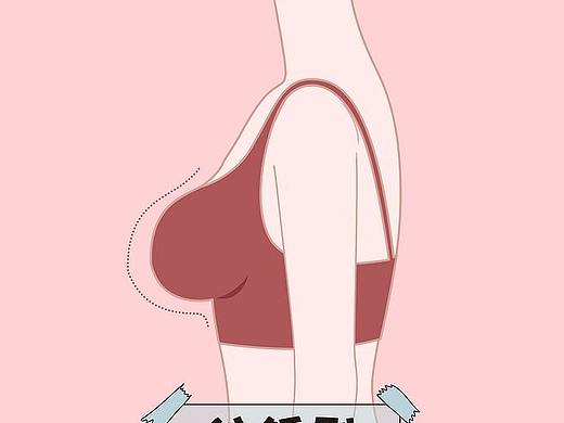 医美胸部、胸型