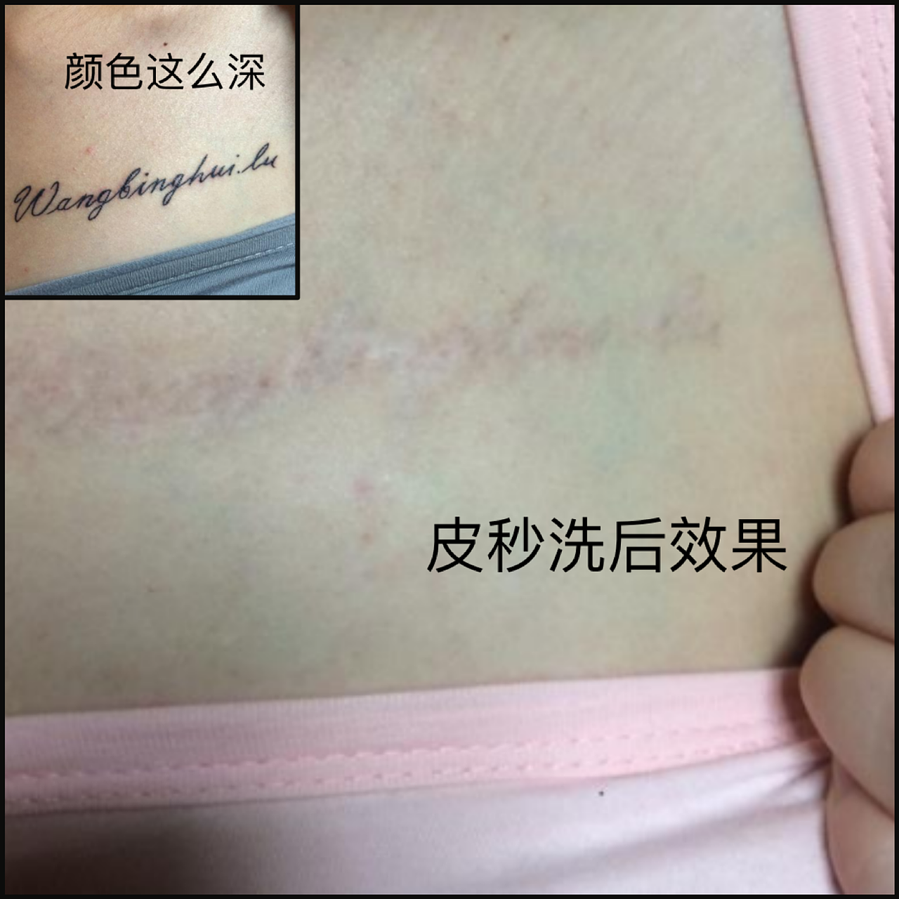 皮秒激光可能是无锡洗纹身的最好方法,无锡激光洗纹身