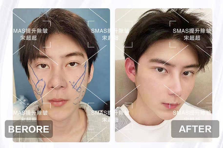 分享收藏宋超超真人对比案例展示宋超超的每一个节日宋超超医生对比图