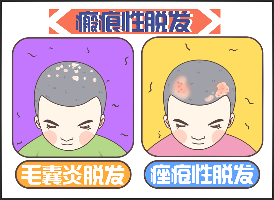 脱发 植发 脱发原因 病理性脱发 产后脱发 发际线