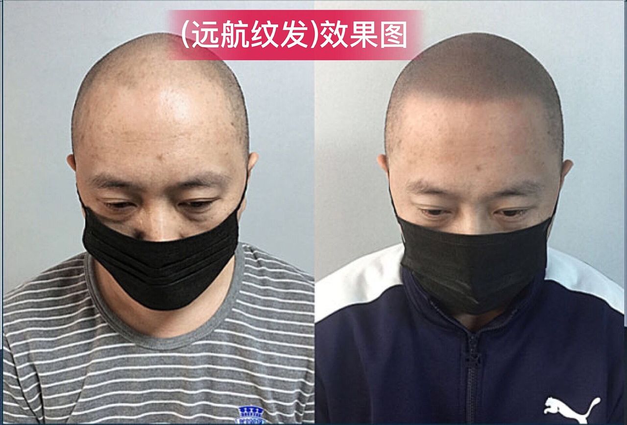 在江苏无锡，纹发帮你解决脱发的不自在和尴尬 ，远航
