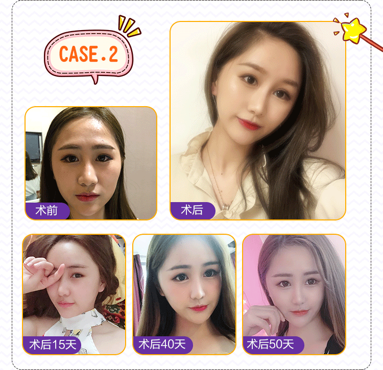 医美自体脂肪面部填充