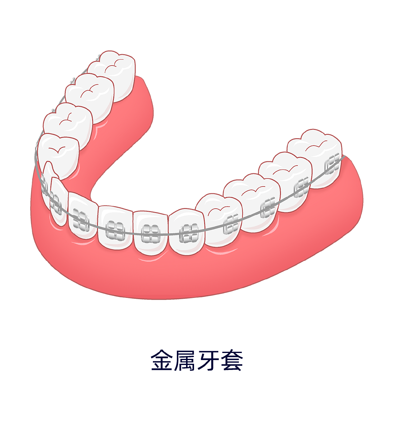 牙齿矫正常见的几种牙套类型哪种好？ - 哔哩哔哩