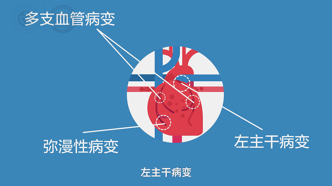 美敦力心脏搭桥手术科普动画