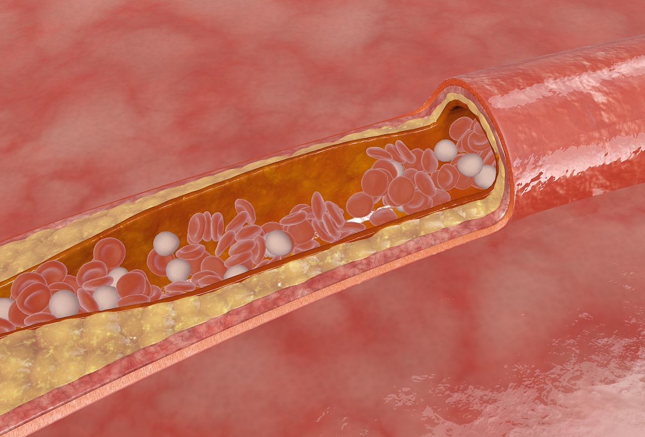 血管阻塞 血管堵塞 心肌梗塞 心脑血管 脑梗3d三维全息