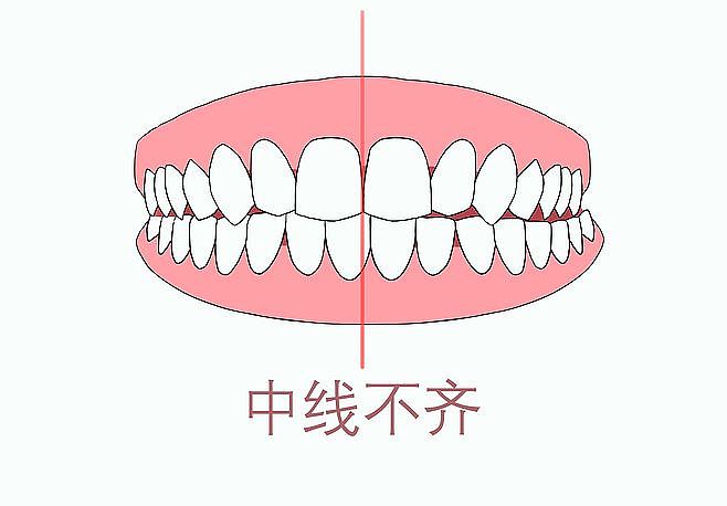 牙齿，口腔，牙齿矫正，龅牙，虎牙，牙齿不齐（图ZMTgyODgyMzMy） - 创作习作 - 站酷设计师没事画画哦原创素材 - 站酷ZCOOL