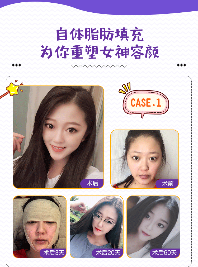 医美自体脂肪面部填充