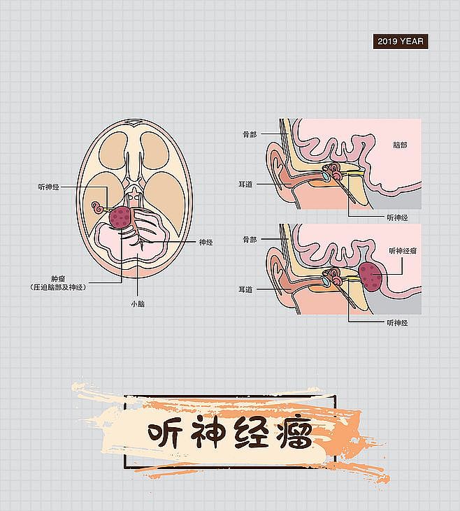 人体神经系统肿瘤