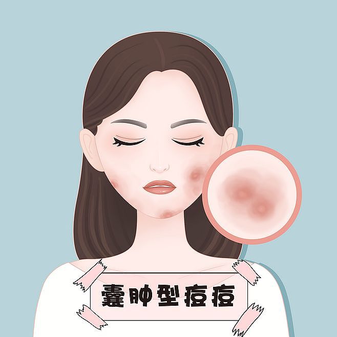 医美、脸部、痘痘、粉刺