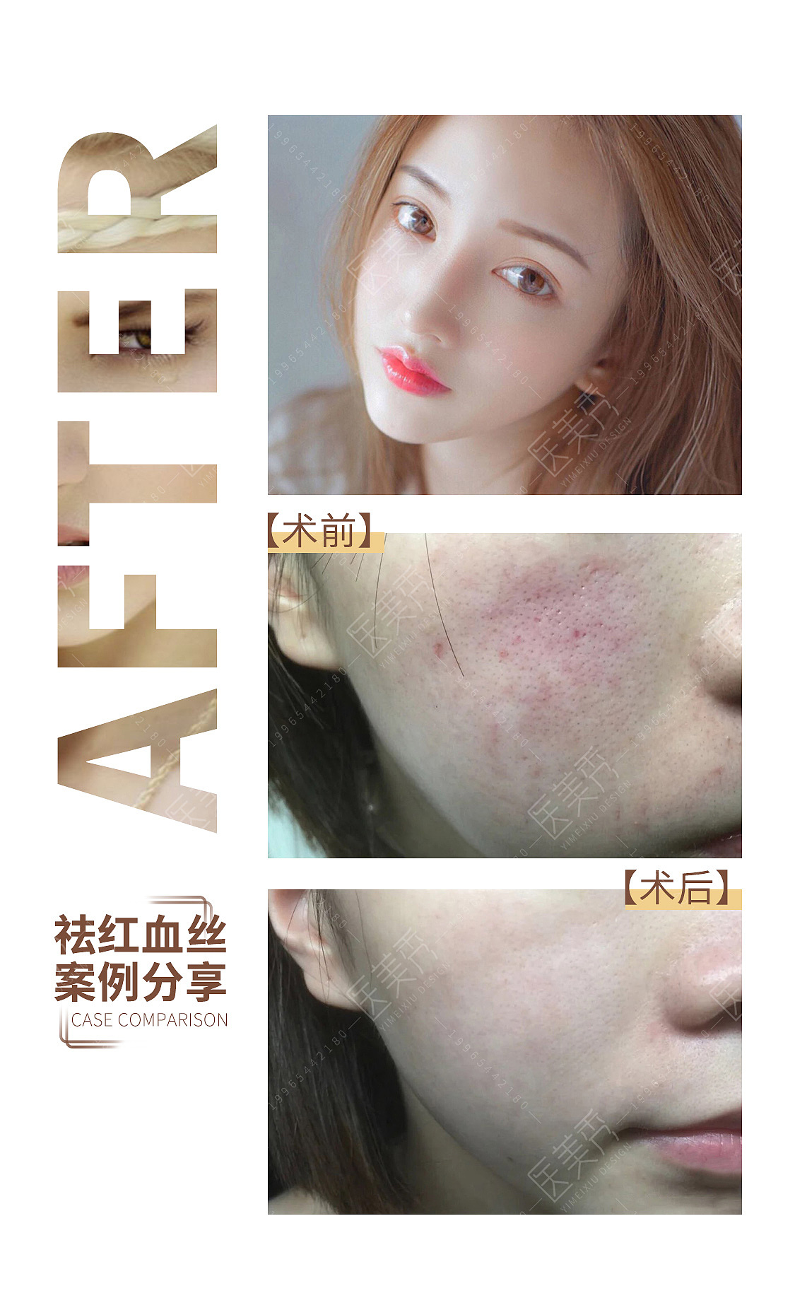 医美案例对比图-合作加19965442180