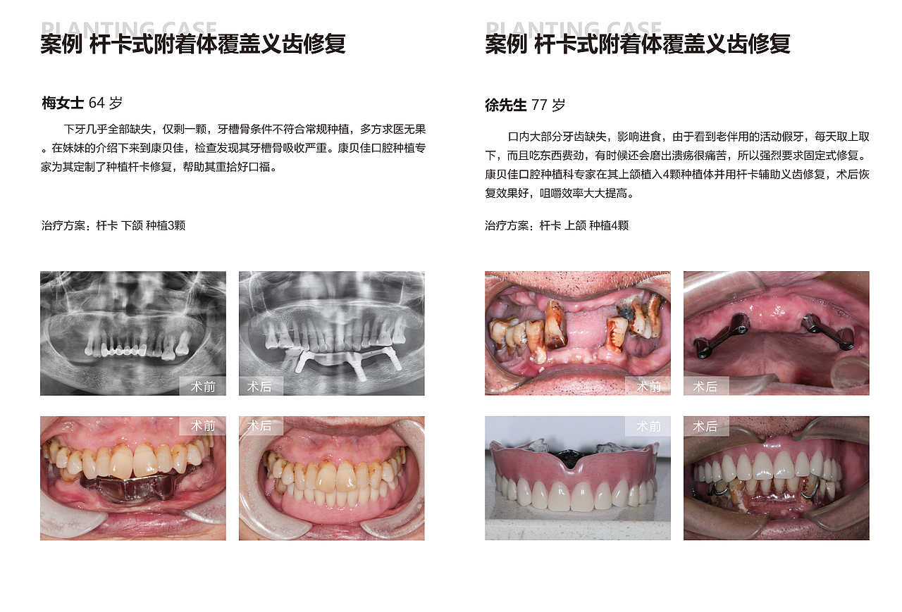 口腔种植牙案例册子 (暂未定稿)（图ZMjg5MTgxNDk2） - 书籍/画册 - 站酷设计师xia夏夏原创素材 - 站酷ZCOOL