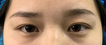 我在郑州双眼皮记录,田氏双眼皮够自然!