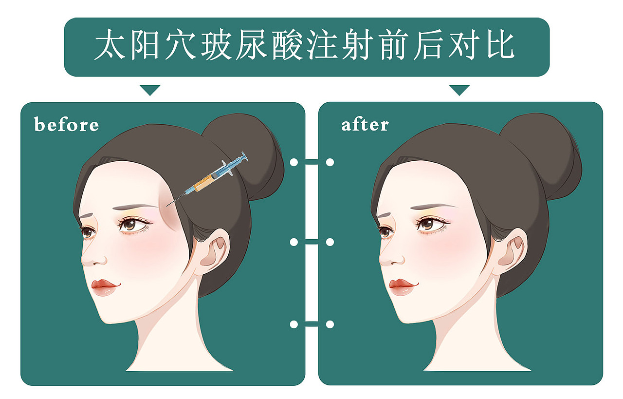 玻尿酸，玻尿酸填充，玻尿酸丰脸部（图ZMTk5NzA4MjQw） - 艺术插画 - 站酷设计师没事画画哦原创素材 - 站酷ZCOOL